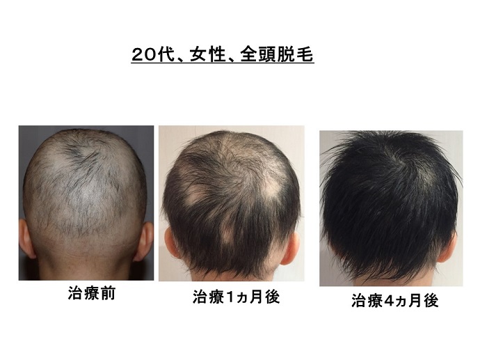 円形脱毛症　病院